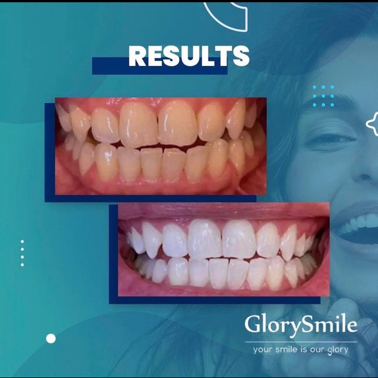 Glorysmile kit de blanchiment dentaire